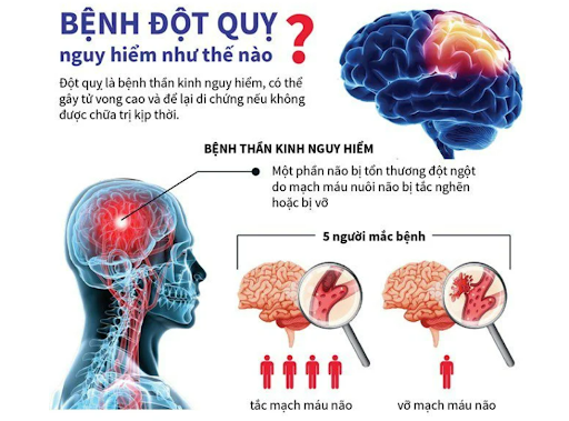 Safi sơ cấp cứu đột quỵ